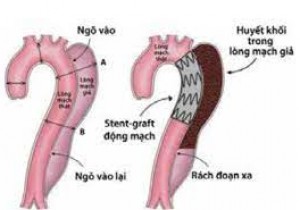 Thông báo về việc mời chào giá các mặt hàng Can thiệp mạch não